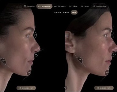 3D肌診断機AURAによる施術前後の比較撮影
